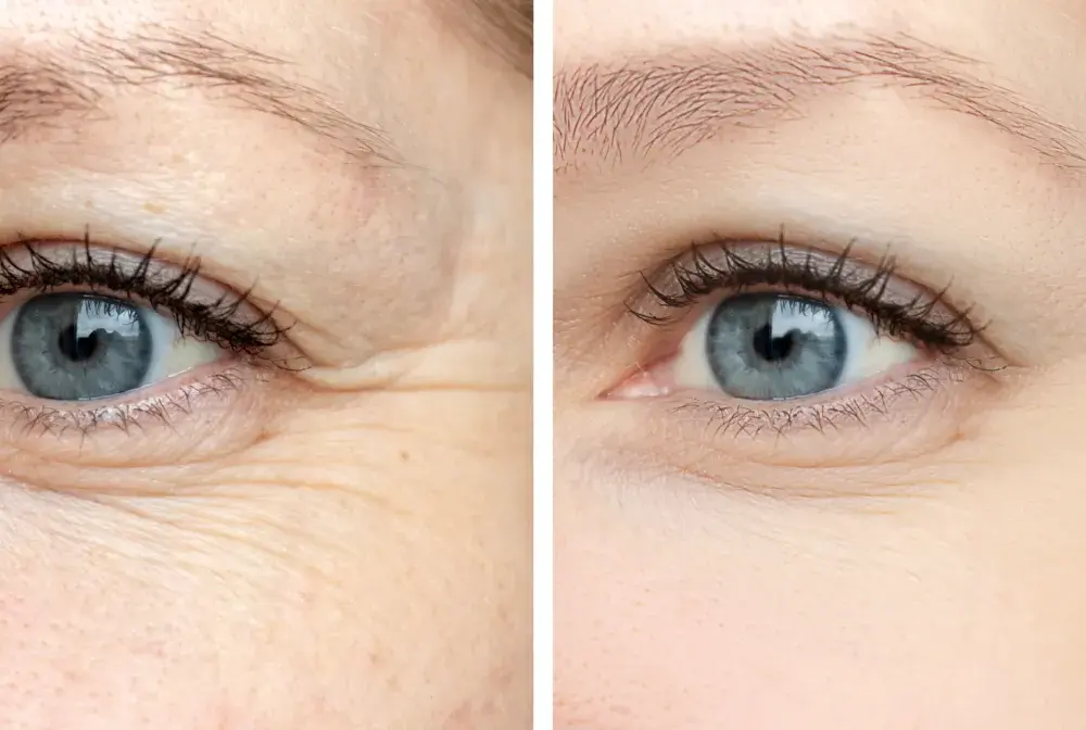 Mezoterapia pod oczy - efekty, koszty, kiedy warto?