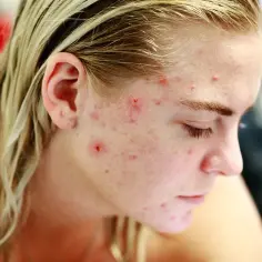 Dziewczyna z pryszczami na twarzy, szukająca skutecznego rozwiązania, być może tribiotic na pryszcze.