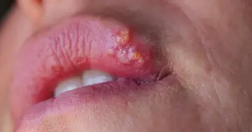 Pęcherzyki na ustach, które powodują piekące usta, są widoczne na zbliżeniu.