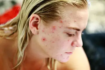 Dziewczyna z pryszczami na twarzy, szukająca skutecznego rozwiązania, być może tribiotic na pryszcze.