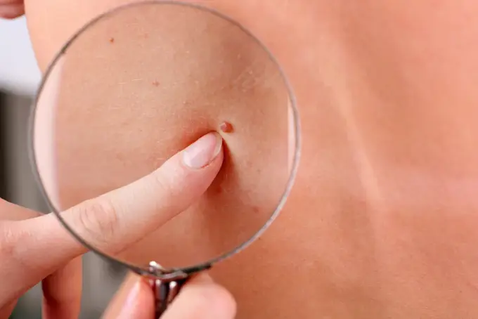 Rozdrapany pieprzyk - jak postępować i kiedy iść do dermatologa?